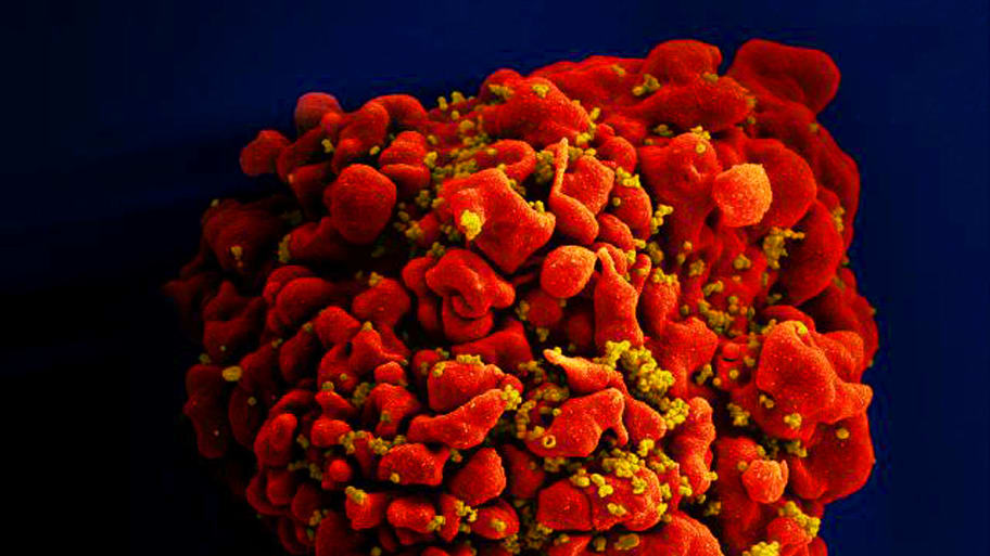 A single, red colored H9-T cell that had been infected by numerous, spheroid shaped, mustard colored human immunodeficiency virus (HIV) particles attached to the cell's surface membrane.