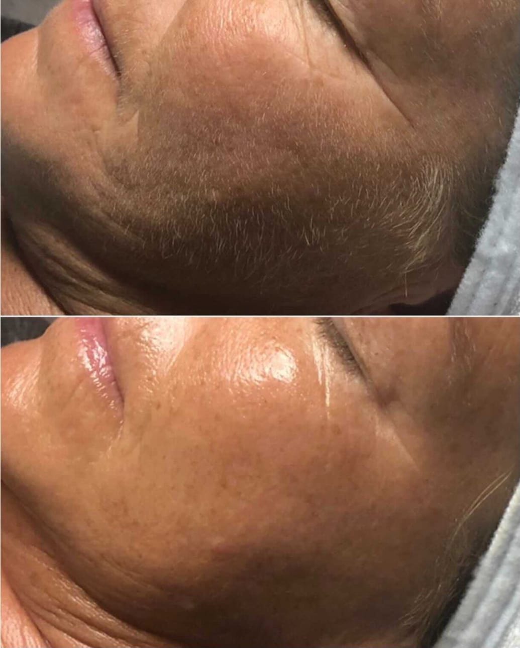 dermaflash before and after