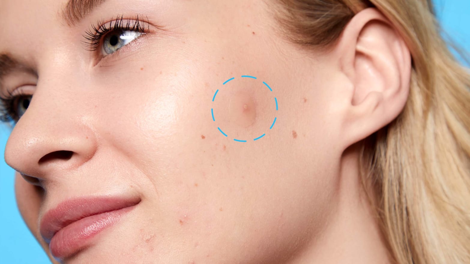 These $12 Pimple Patches Made My Cystic Acne Disappear Overnight