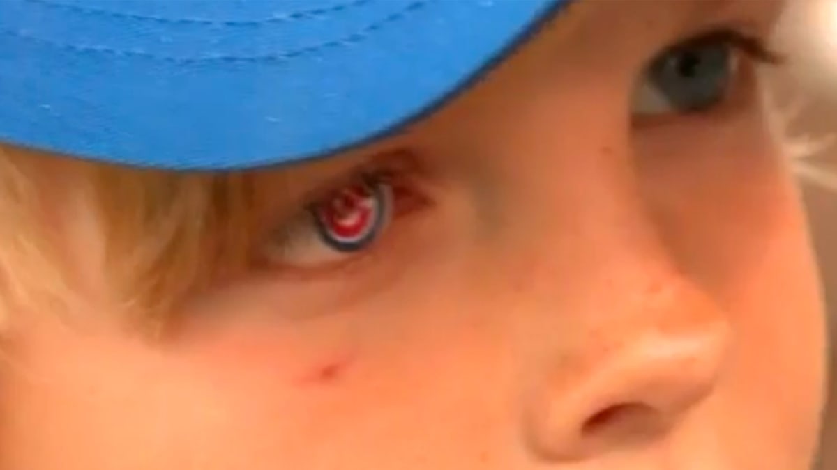 Central Illinois cancer survivor, 7, gets prosthetic Cubs eyeball