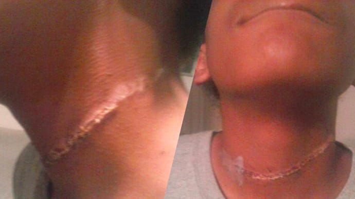 No charges filed in case involving Waco girl with rope burns to neck