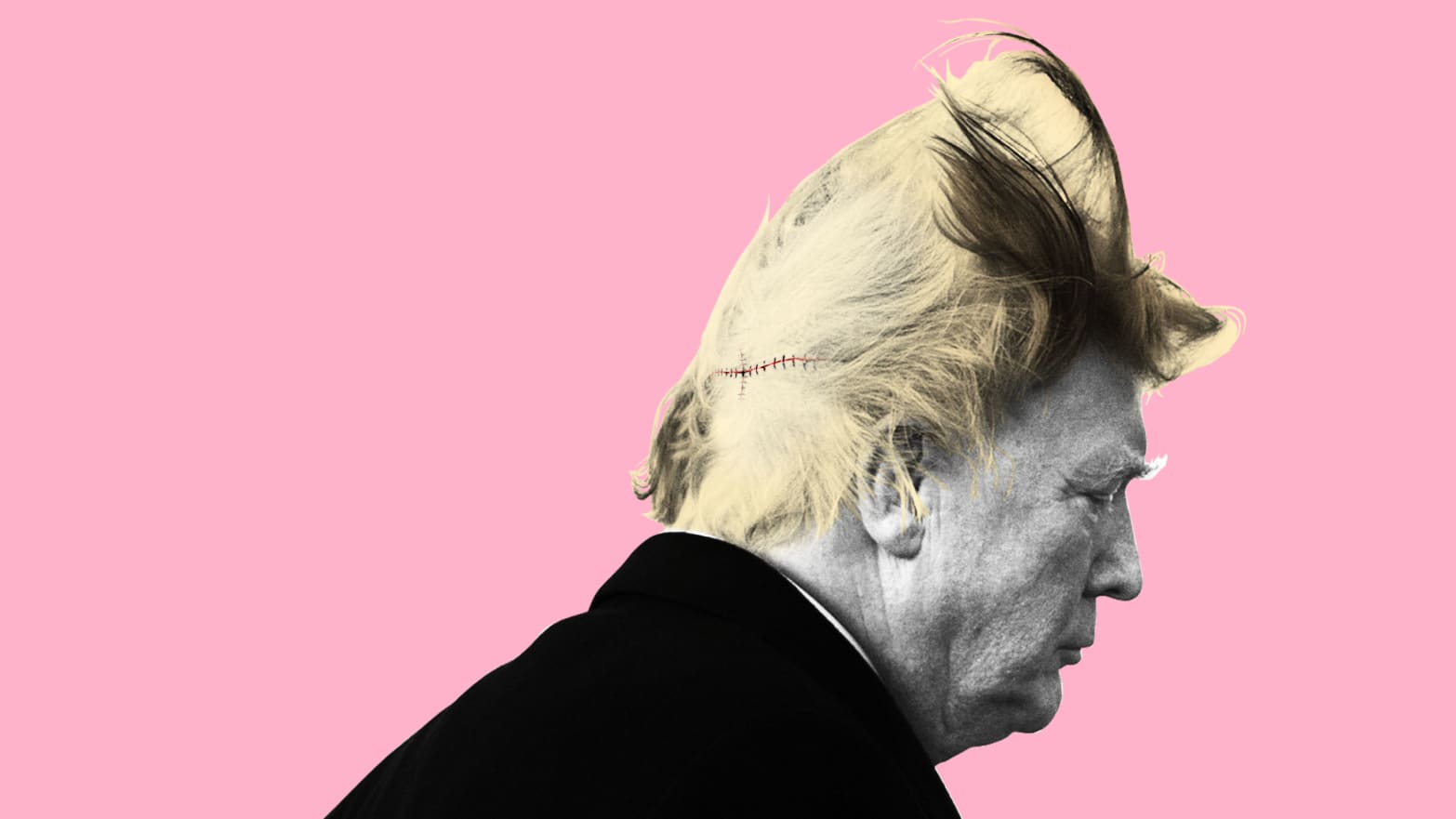 Plastic Surgeons Try to Solve Trump's Hair Mystery