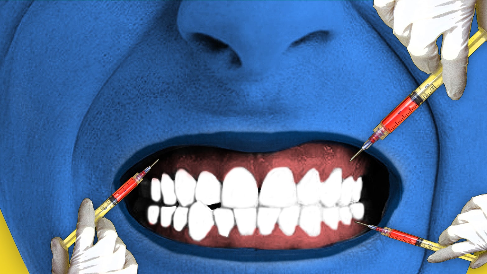 bruxism botox teeth grinding stress dental dentistry plastic surgery wrinkle