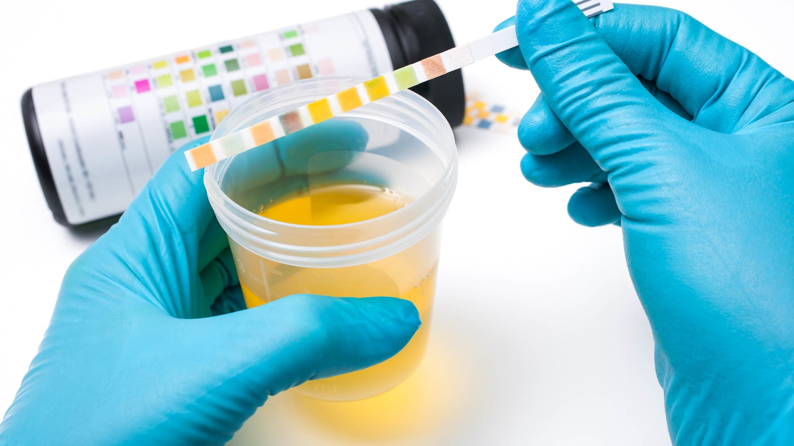 urinary tract infection uti image of blue hand glove holding urine sample with colored paper