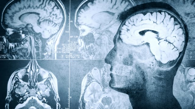 transcranial magnetic stimulation tms depression schizophrenia memory dementia parkinsons alzheimers remember sound