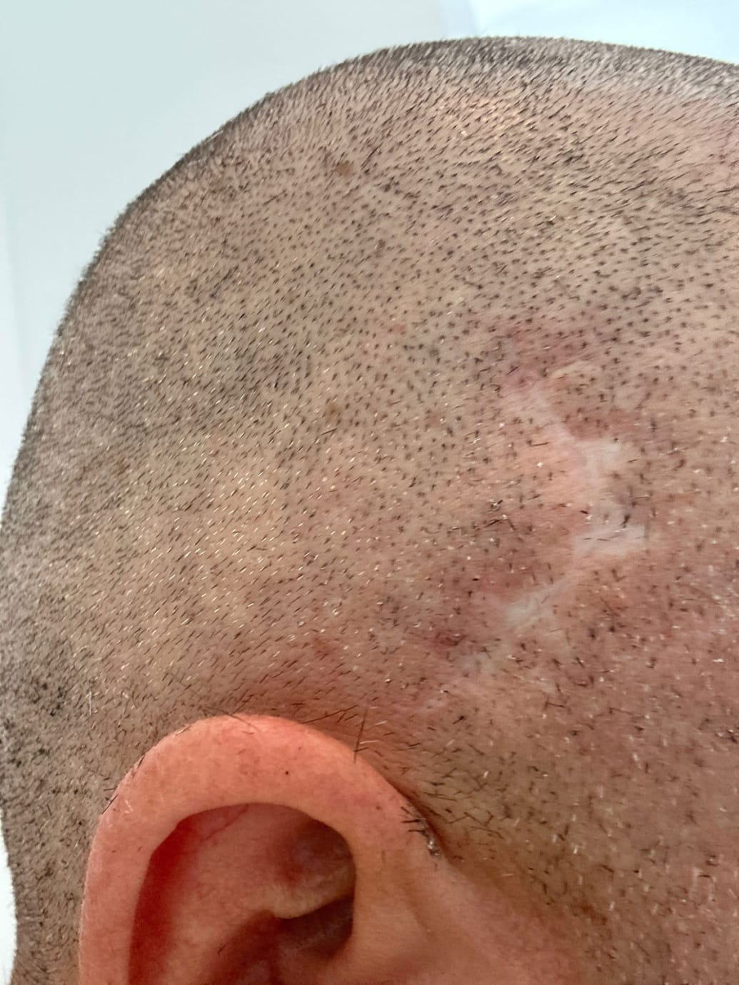 A jagged scar on Eric Lamaze’s head.