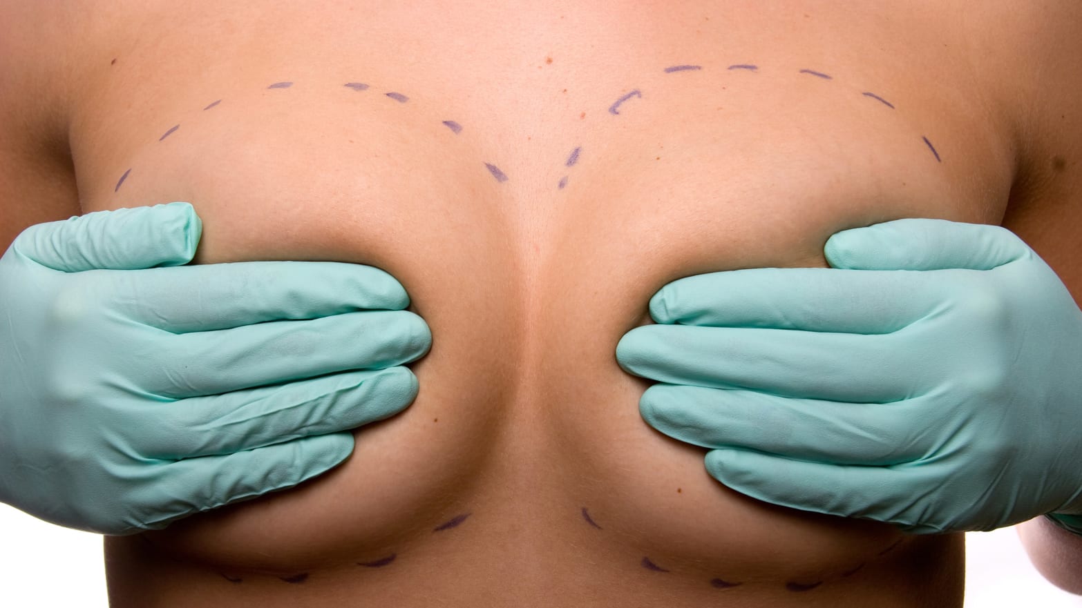 image of woman holding her breasts pressing against nipples with pen-marked dashes going around them breast cancer implant mesh 3d fda illness