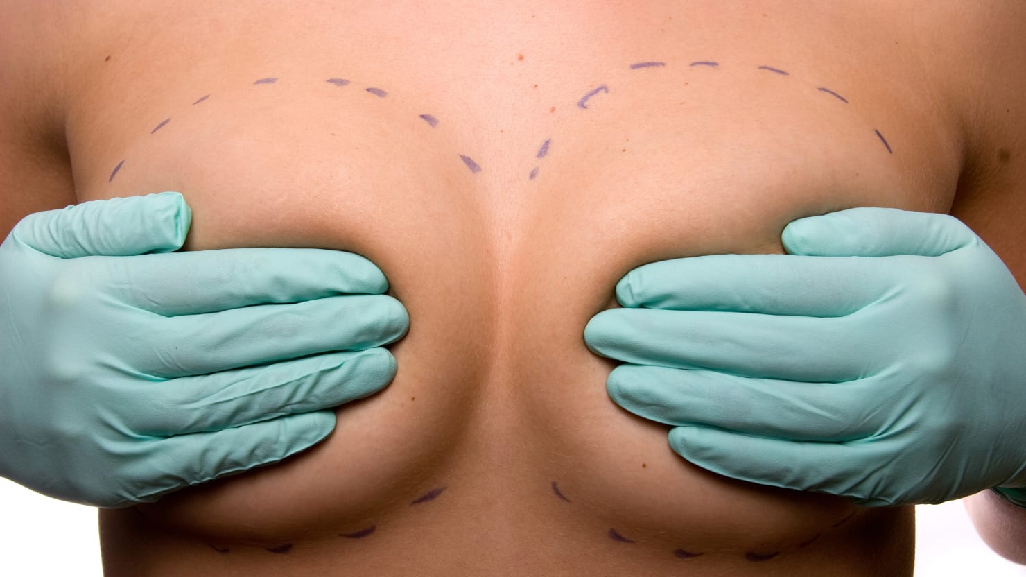 Breast Augmentation Revision Surgery
