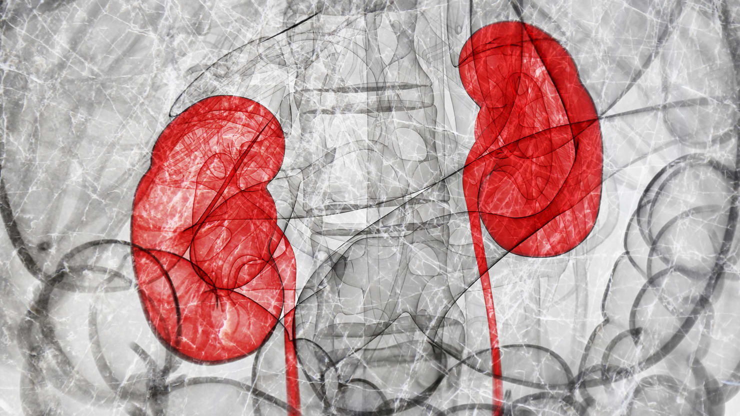 The Campaign to Purge Racial Bias From a Decades-Old Medical Tool Used to Assess Kidney Health