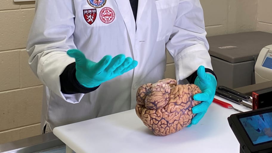 Dr. Ann McKee, Chief of Neuropathology, VA Boston examines the brain of a 47-year old former college football player looking for signs of CTE in Boston.