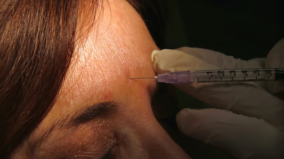 A dermatologist demonstrates how botox or other anti-wrinkle medicines are applied via syringe to a patient at his office in New York City, March 22, 2013. 
