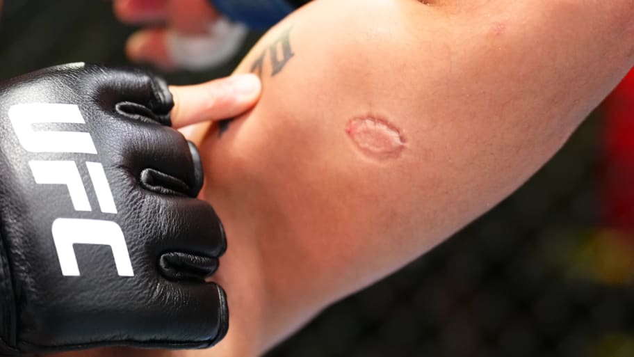 A bite mark on the arm of Andre Lima