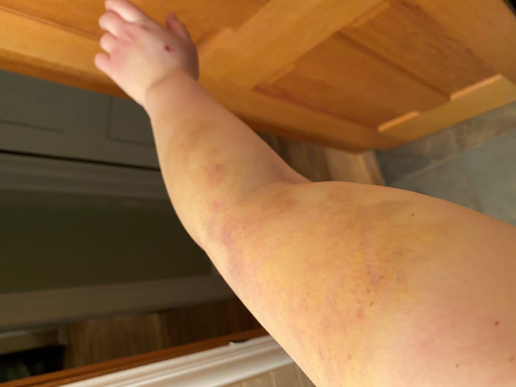 Patricia Day’s injured arm after her encounter with officer Derek Chauvin.