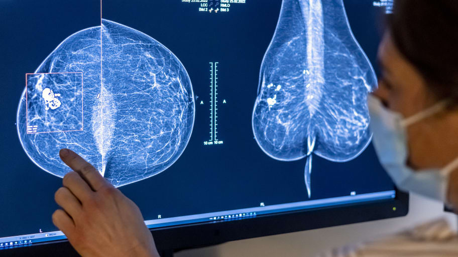 Medical personnel use a mammogram to examine a woman's breast for breast cancer.