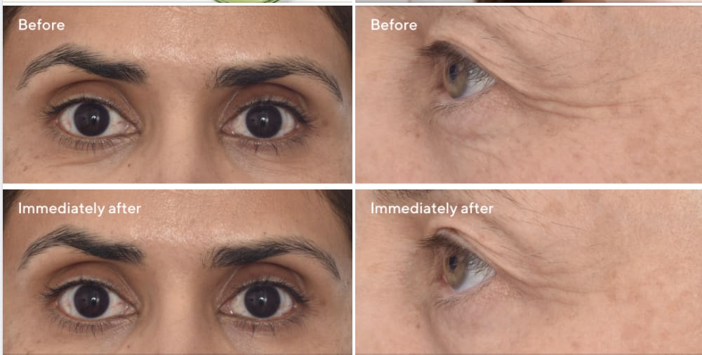 Murad eye mask dr zion before and after