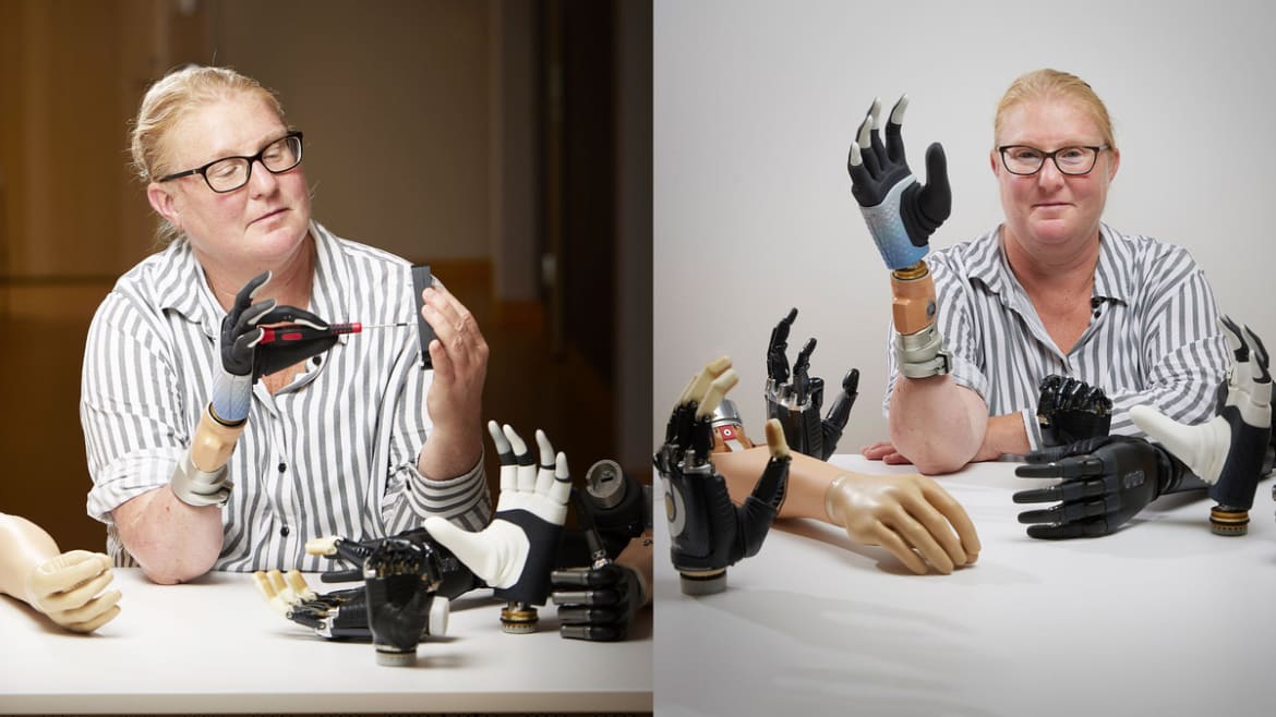 Is This Bionic Hand the ‘Holy Grail’ of Prosthetics?