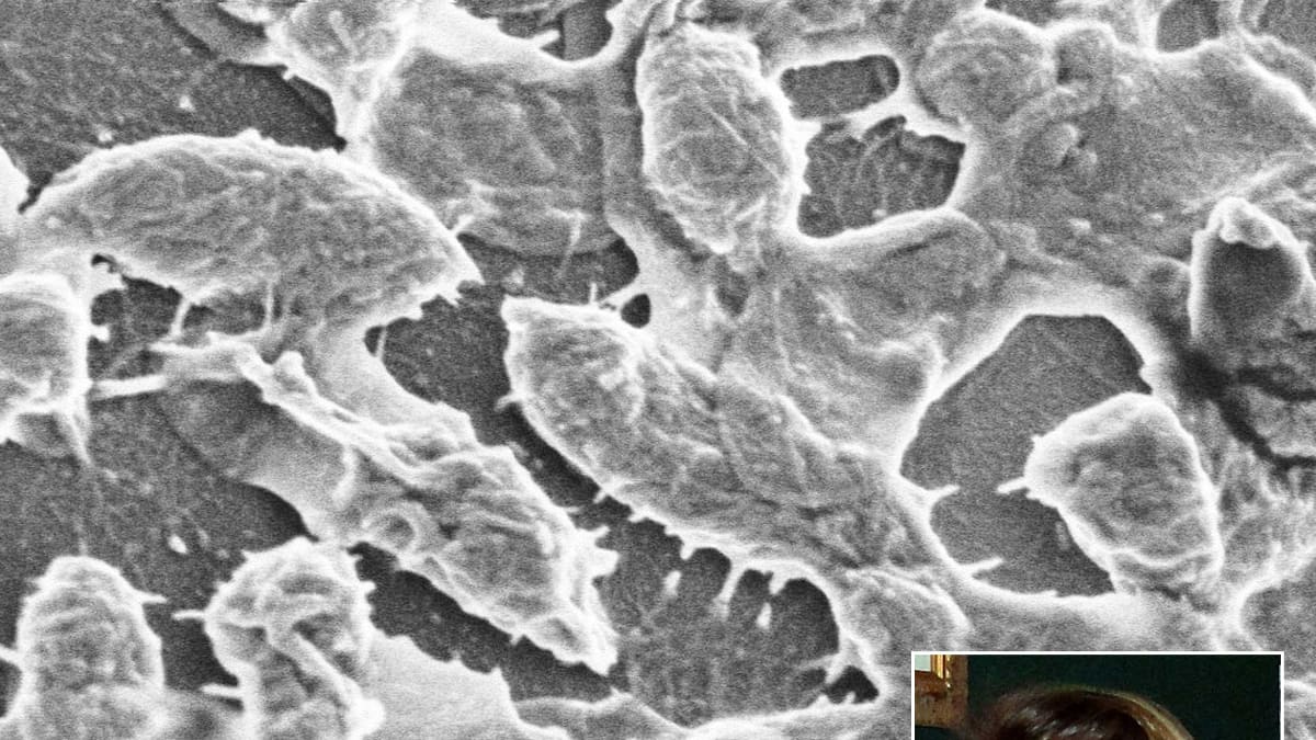 Necrotizing Fasciitis: Life After Flesh-Eating Bacteria