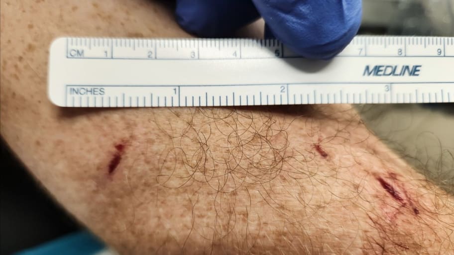 A man camping in Colorado was bitten by a black bear.