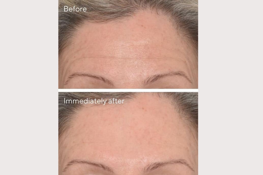 Murad Targeted Wrinkle Corrector Before and After